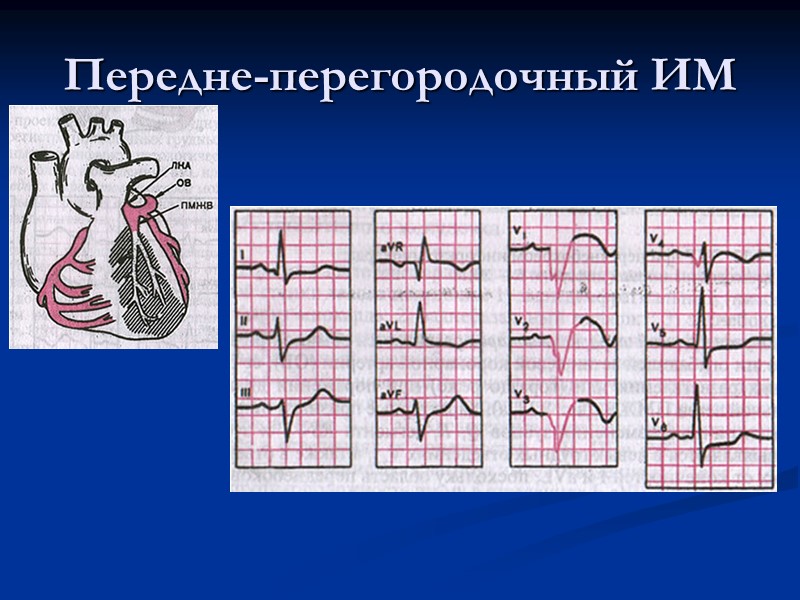 Передне-перегородочный ИМ